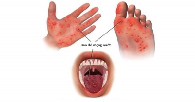 Dấu hiệu của bệnh tay chân miệng